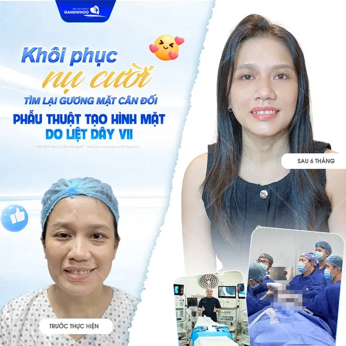 Khôi phục nụ cười tìmlại gương mặt cân đối phẫu thuật tạo hình mặt do liệt dây VII