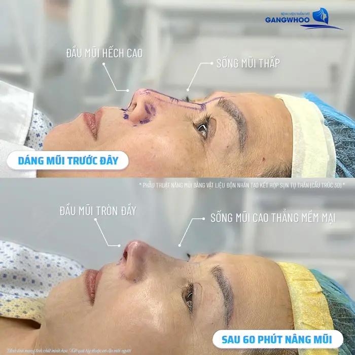 Sau 60 phút phẫu thuật nâng mũi nhan sắc và diện mạo thay đổi rõ rệt ngay sau khi thực hiện