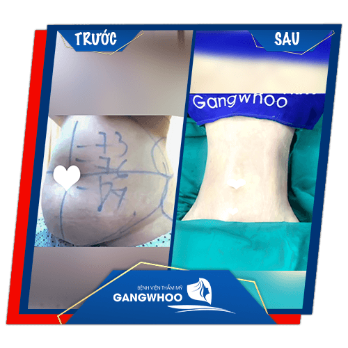 "Ưu Đãi 50%" Lipo Ultrasound Vắt Kiệt Mỡ Thừa 1 Lần Duy Nhất 21 lipo 10