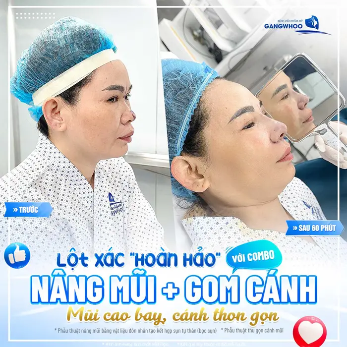 Lột xác hoàn hảo cho khách hàng với combo nâng mũi và gom cánh mũi