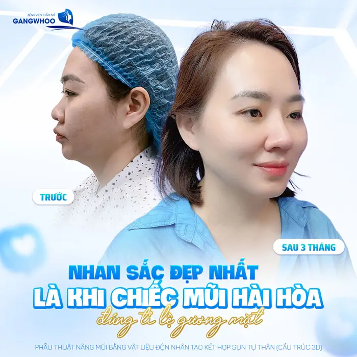 Nhan sắc lên hương đẹp hài hòa và cuốn hút với 1 dáng mũi mới đúng tỷ lệ khuôn mặt