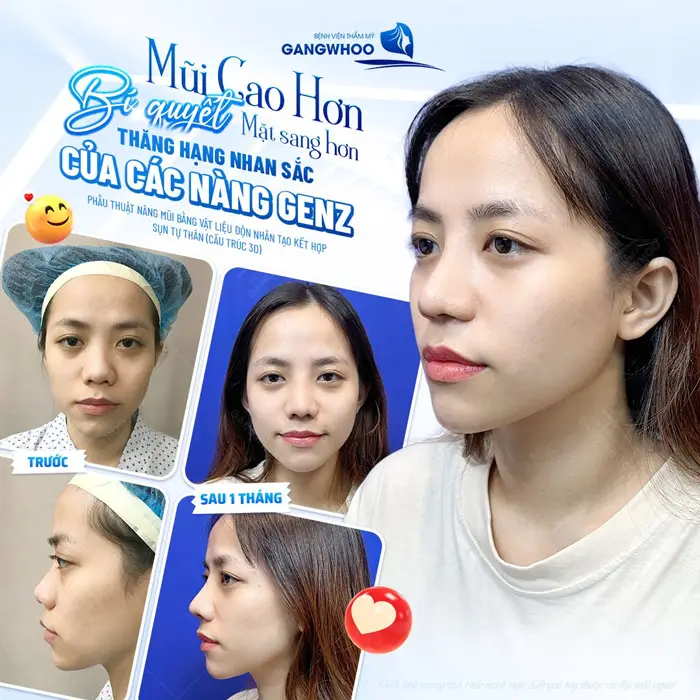 Nâng Mũi Cấu Trúc Có Vĩnh Viễn Không? 4 Yếu Tố Quyết Định 1 Mũi cao hơn bí quyết cho gương mặt sang đẹp thăng hạng nhan sắc của GenZ