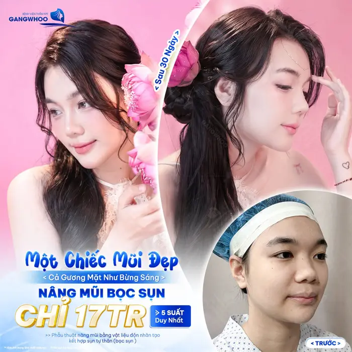 1 chiếc mũi đẹp có gương mặt bừng sáng nâng mũi bọc sụn không lo áp lực chi phí