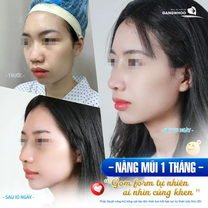 Nâng mũi 1 thang gom form tự nhiên ai nhìn cũng khen vì diện mạo thăng hạng và đẹp xuất sắc