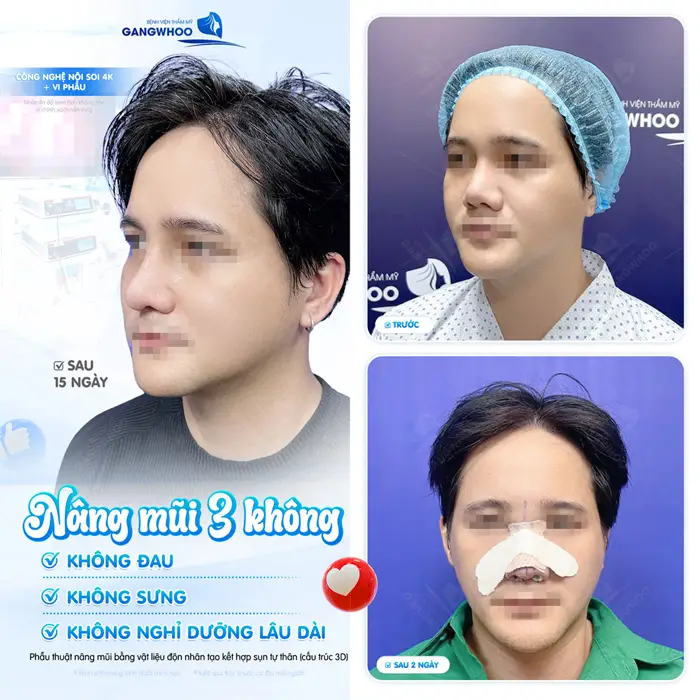 Nâng mũi 3 không tại BVTM Gangwhoo khách hàng yên tâm về kết quả hài lòng về trải nghiệm