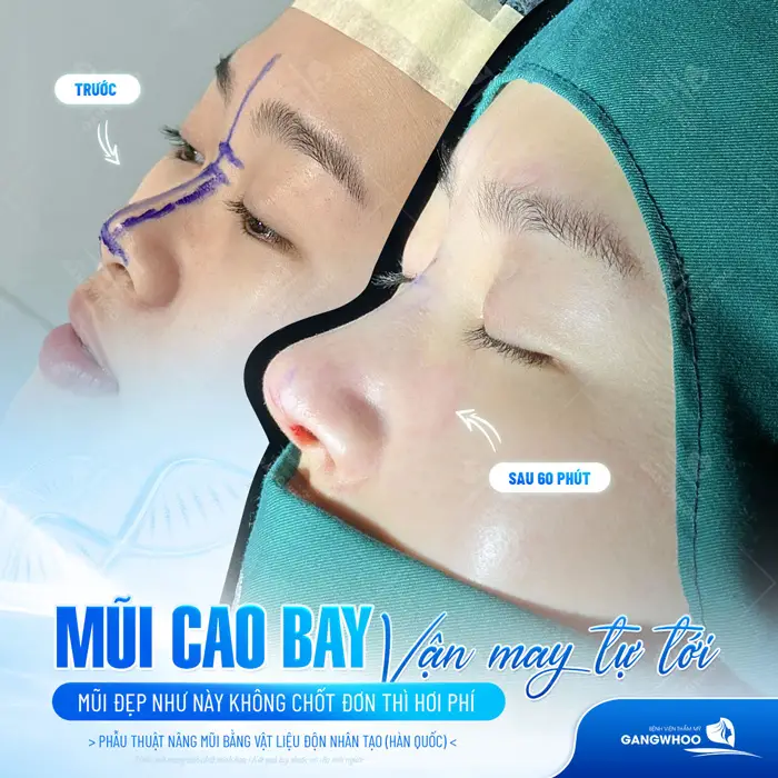Mũi cao bay vận may tự tới mũi đẹp an toàn ngay sau 60 phút thực hiện với kỹ thuật chuẩn hóa
