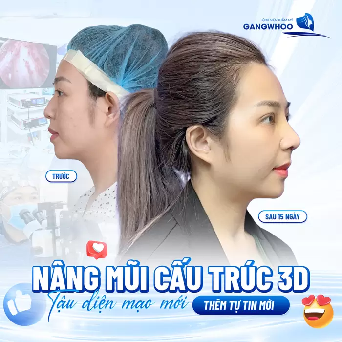 Nâng mũi cấu trúc 3D diện mạo mới, thăng nhan nhan sắc lên tầm cao mới