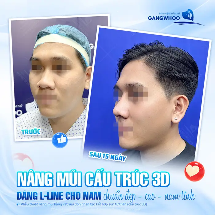 Phẫu thuật nâng mũi cho dáng mũi L Line chuẩn đẹp, cao thanh thoát và mềm mại sau 15 ngày