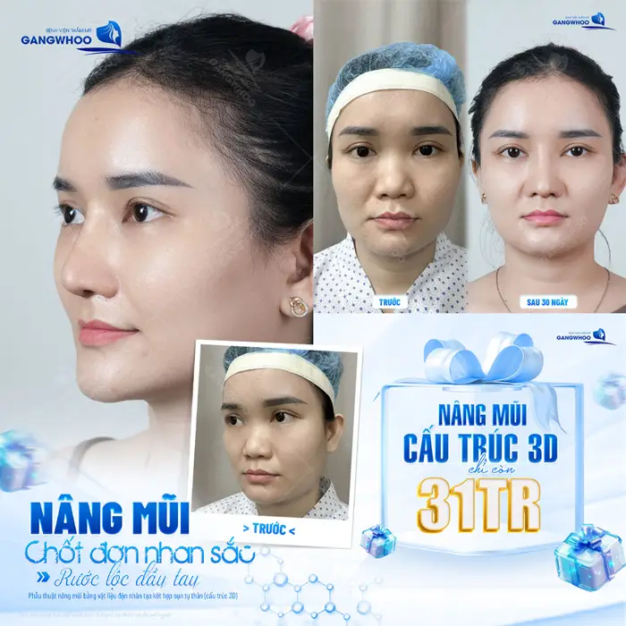 Nâng mũi cấu trúc chốt đơn nhan sắc bước ngoặt cho một diện mạo xinh đẹp dài lâu 