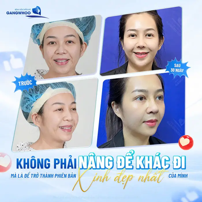 Nâng mũi an toàn, hiệu quả sự lột xác sau 15 ngày hóa thân thành phiên bản hoàn hảo sau phẫu thuật