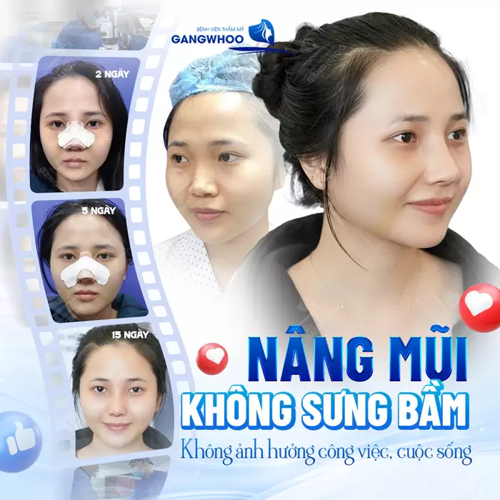 Nâng mũi không sưng bầm, không ảnh hưởng đến công việc và cuộc sống