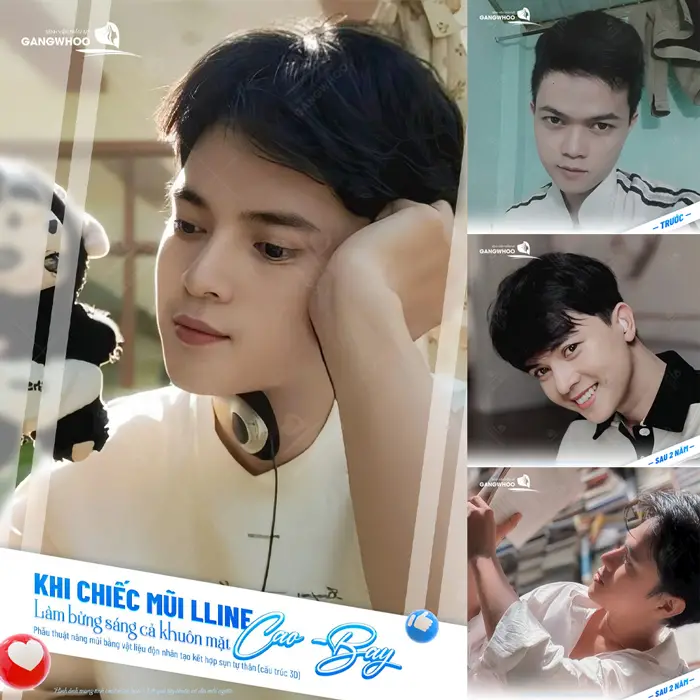 Dáng mũi L Line cao bay tôn lên nét đẹp hoàn hảo cho diện mạo gương mặt thêm cuốn hút và đẹp chuẩn thần thái