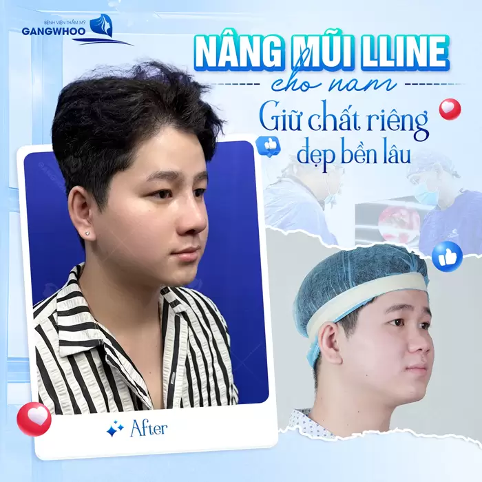 Nâng Mũi L Line Là Gì? Phù Hợp Với Những Khuôn Mặt Nào? 1 Nâng mũi L Line cho nam giữ chất riêng đẹp bền lâu an toàn, hiệu quả mà vẫn hút thần thái điển trai