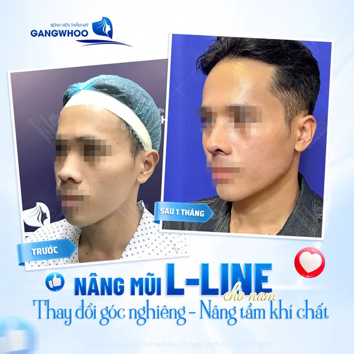 Nâng mũi L Line htay đổi góc nghiêng nâng tầm khí chất cho nam giới