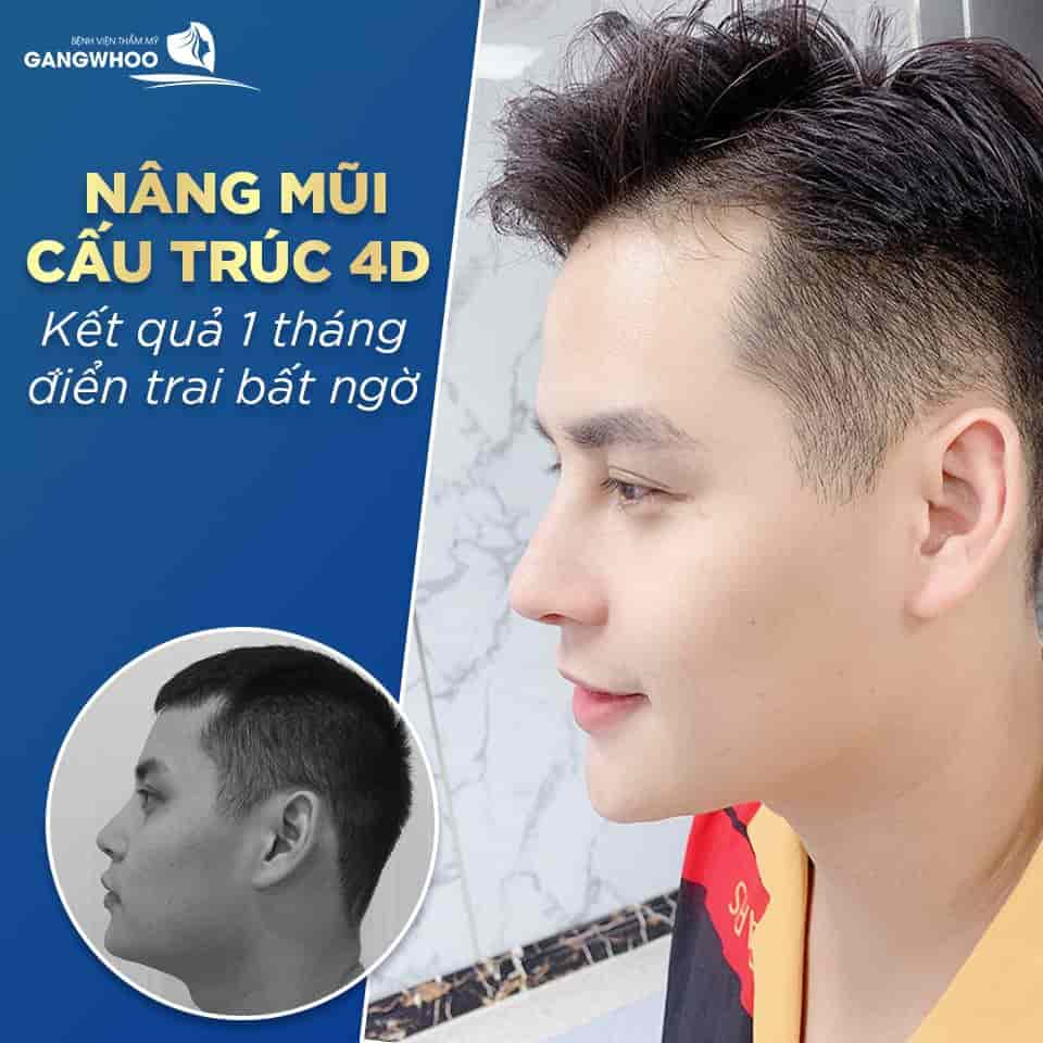 IMAGES OF OUR CUSTOMERS BEFORE & AFTER RHINOPLASTY FOR MEN AT GANGWHOO COSMETIC HOSPITAL