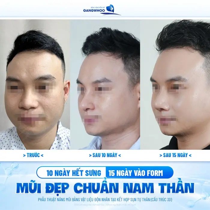 10 ngày hết sưng mũi vào form đẹp chuẩn nam thần tự tin với diện mạo mới đẹp thăng hạng