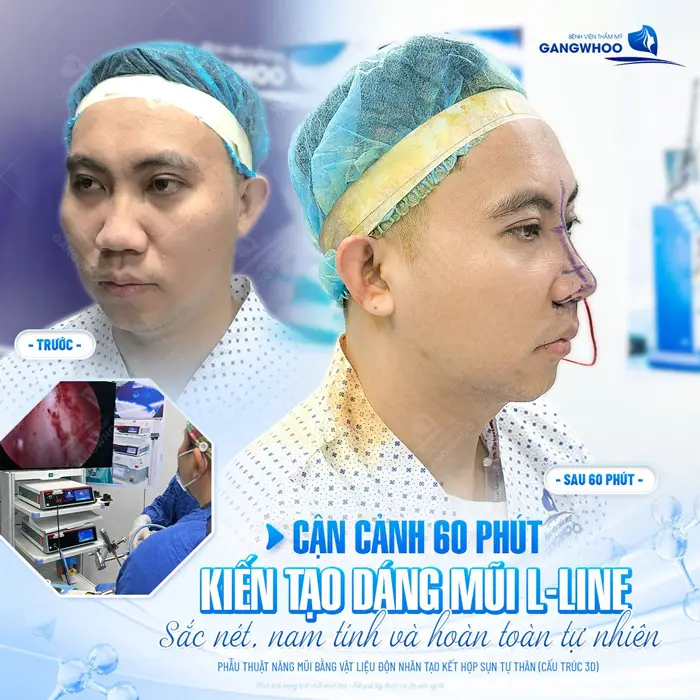 Cận cảnh 60 phút dáng mũi L Line đẹp chuẩn được hoàn thành đẹp sắc nét, chuẩn nam tính và mềm mại tự nhiên