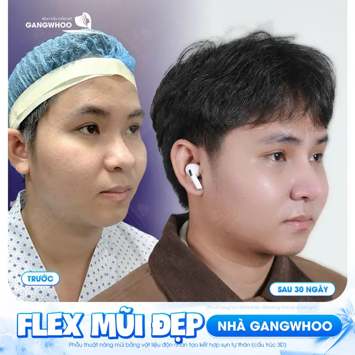 Flex dáng mũi đẹp chuẩn sau 30 ngày của khách hàng BVTM Gangwhoo