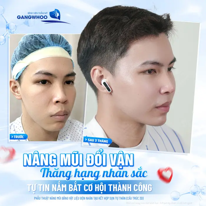 Nâng mũi đổi vận nam giới thăng hạng nhan sắc tự tin nắm bắt cơ hội thành công trong tương lai