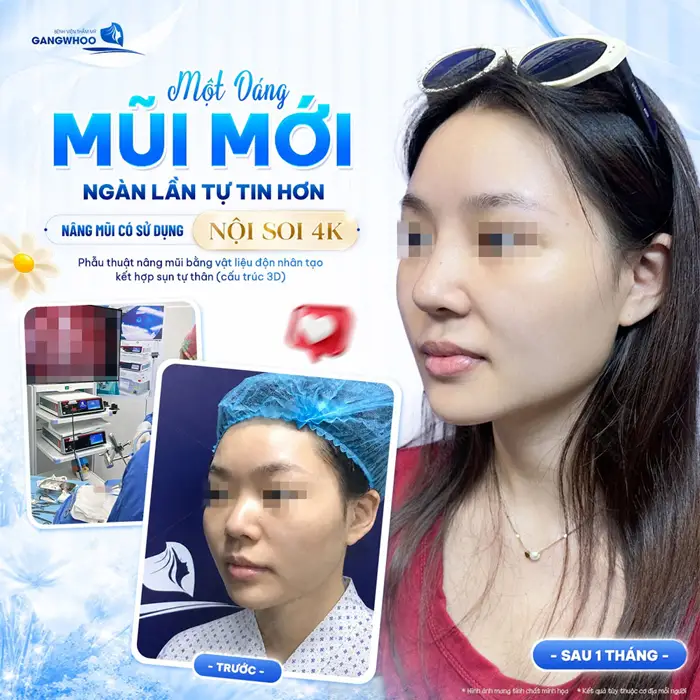 5+ Địa Chỉ Nâng Mũi Uy Tín Tại TPHCM 7 1 dáng mũi mới ngàn lần tự tin sau nâng mũi có sử dụng công nghệ nội soi 4K