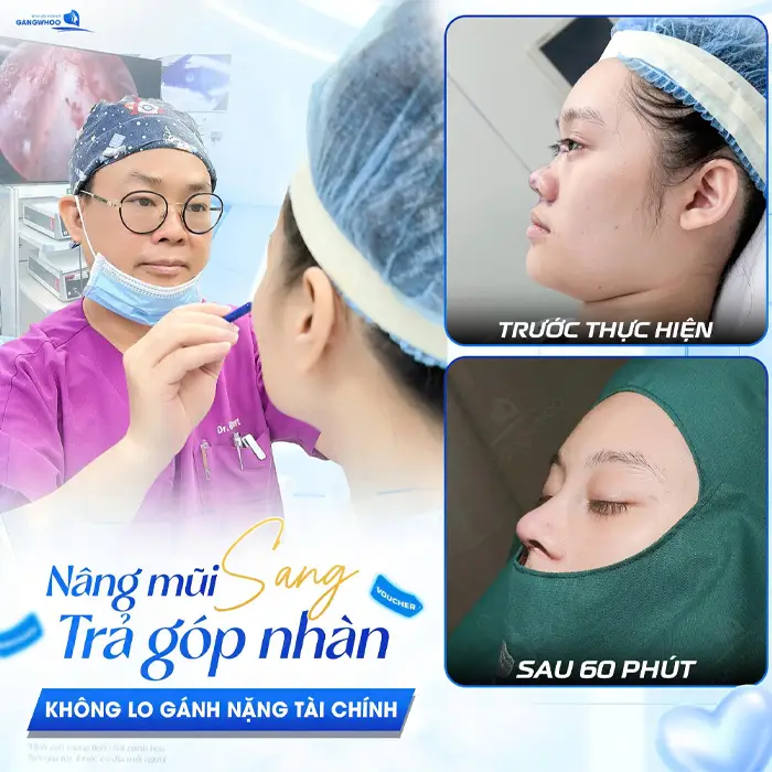 Nâng Mũi Trả Góp 0% - Nâng Mũi Đẹp Chẳng Lo Giá