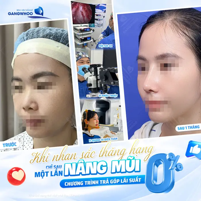 Nâng Mũi Trả Góp 0% - Nâng Mũi Đẹp Chẳng Lo Giá