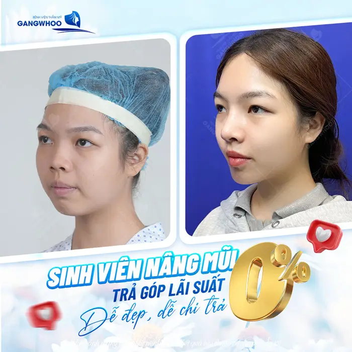 Nâng Mũi Trả Góp 0% - Nâng Mũi Đẹp Chẳng Lo Giá