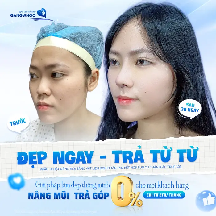 Nâng Mũi Trả Góp 0% - Nâng Mũi Đẹp Chẳng Lo Giá