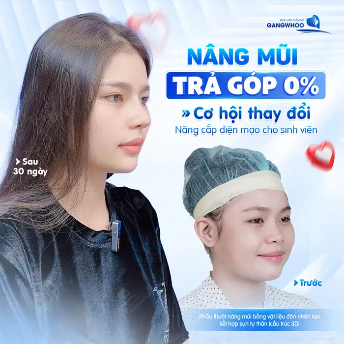 Nâng mũi trả góp cơ hội thay đổi nâng cấp diện mạo cho sinh viên 