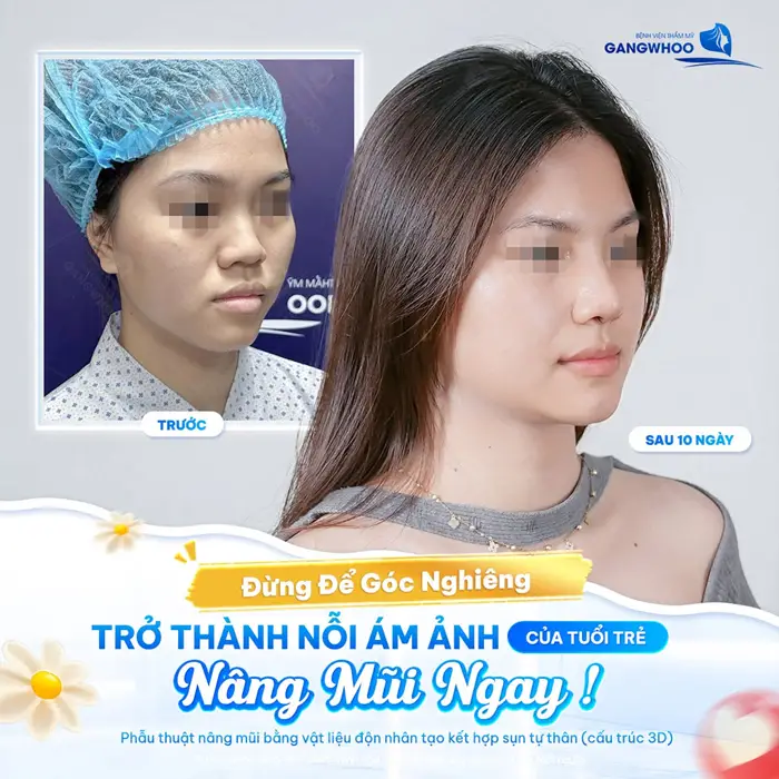 Nâng mũi góc nghiêng thêm cuốn hút sau 10 ngày nhan sắc đã xinh đẹp và rạng rỡ hơn 
