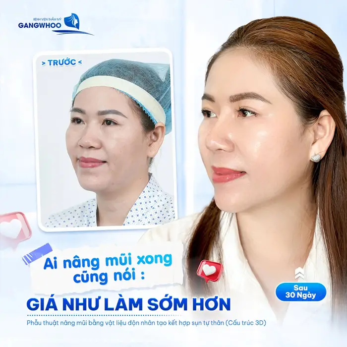 Nâng mũi xong vì thấy hối hận vì không làm sớm hơn