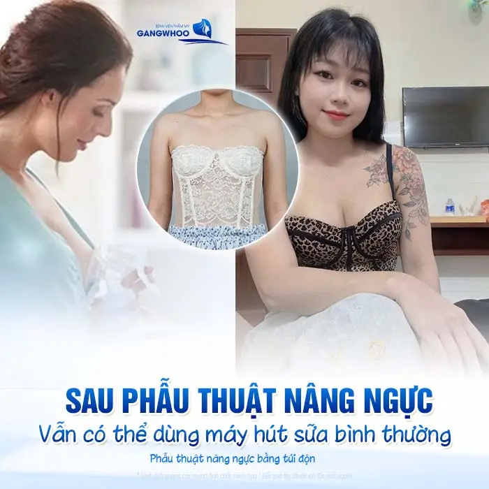 Nâng Ngực Có Dùng Máy Hút Sữa Được Không? Bác Sĩ Giải Đáp
