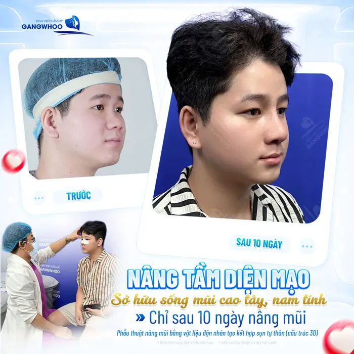 Nâng tầm diện mạo sở hữu sống mũi cao tây, nam tính chỉ sau 10 ngày đã hoàn toàn thay đổi đến khó tin 