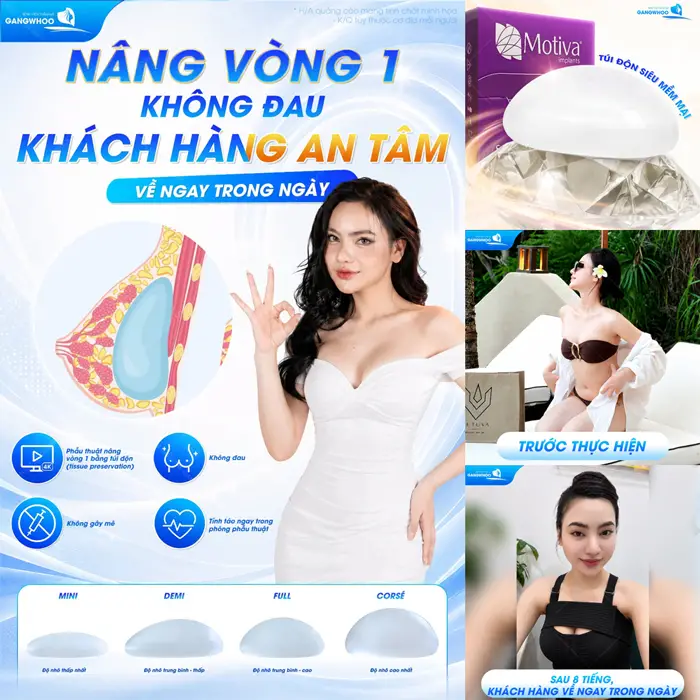 Nâng vòng 1 không đau, không cần nghỉ dưỡng dài lâu có thể về ngay trong ngày