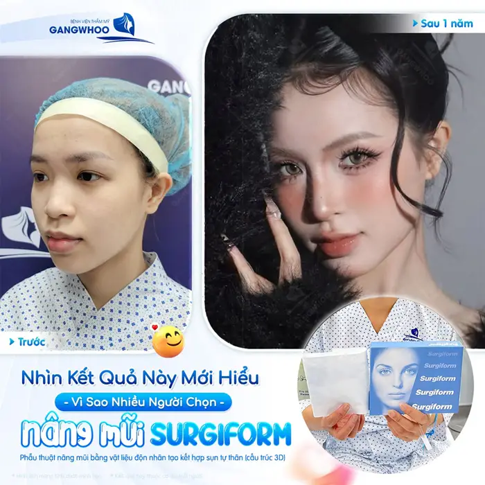 Sụn Nâng Mũi Hàn Quốc Là Gì? Có Bao Nhiêu Loại? Có Tốt Không? 3 Kết quả nâng mũi bằng sụn Surgiform lựa chọn được nhiều người yêu thích