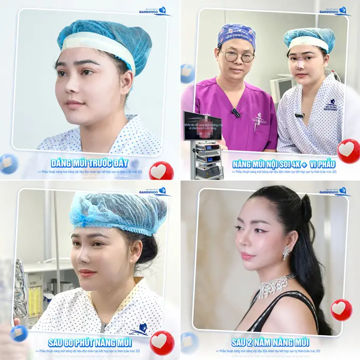 Sau 2 năm nâng mũi nhan sắc ngày càng đẹp và thăng hạng rõ rệt 