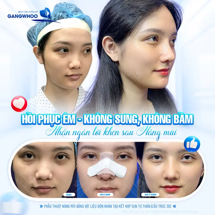 Phẫu thuật nâng mũi sau thực hiện mũi cao đẹp, tự nhiên nhanh hồi phục không sưng, sưng bầm