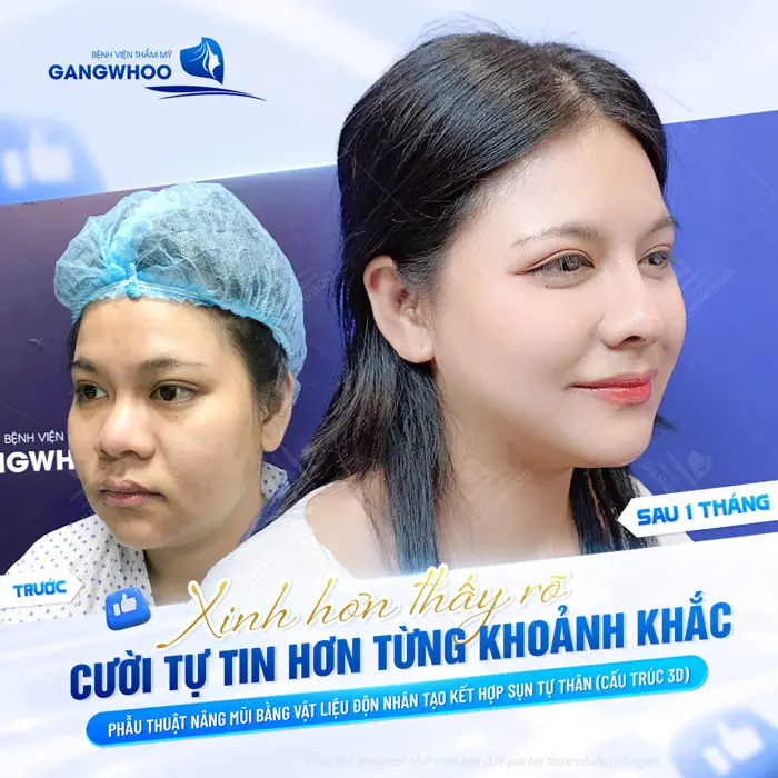 Sau 1 tháng nụ cười tự tin hơn trong từng khoảnh khắc sau phẫu thuật nâng mũi bằng vật liệu độn nhân tạo kết hợp sụn tự thân