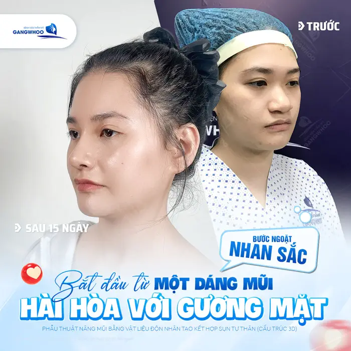 Một dáng mũi cao đẹp hài hòa tôn lên vẻ đẹp và sự thần thái cho tổng thể gương mặt