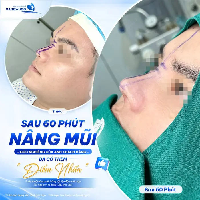 Nâng Mũi Bọc Sụn Được Bao Lâu? Cách Chăm Sóc Duy Trì Lâu Dài 5 Kết quả sau 60 phút nâng mũi góc nghiêng của khách hàng có thêm điểm nhấn cuốn hút và đầy rạng rỡ