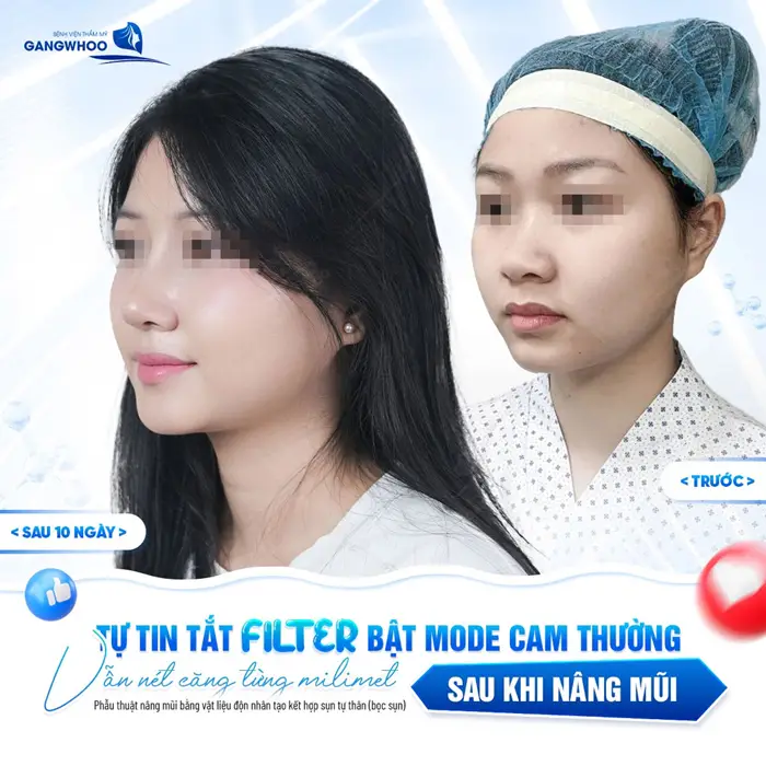 Mặt xinh mặt nét gương mặt thêm cuốn hút chỉ sau 10 ngày nâng mũi 