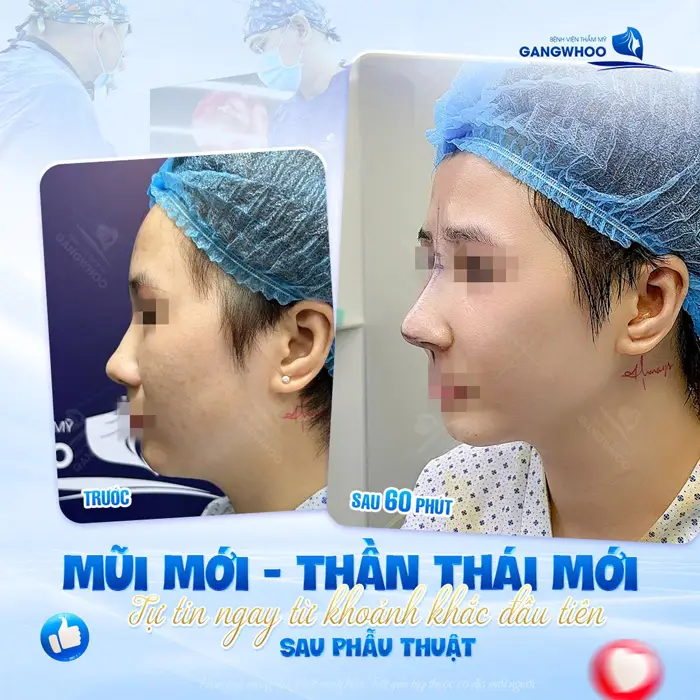 Tự tin ngay từ khoảnh khắc đầu tiên sau 60 phút phẫu thuật mũi mới, thần thái mới