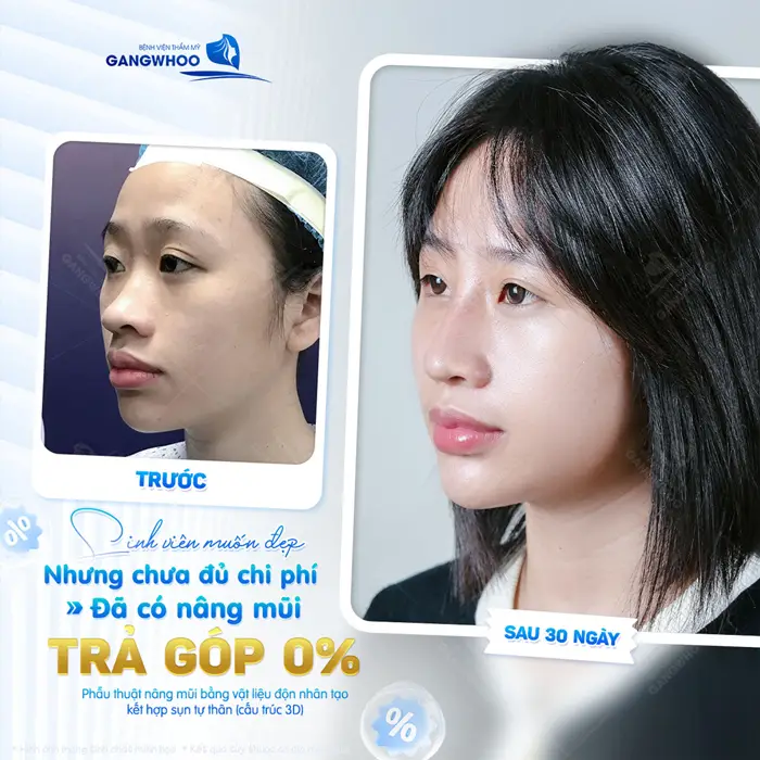Sinh viên muốn đẹp nhưng chưa đủ chi phí đã có nâng mũi trả góp lãi suất 0%
