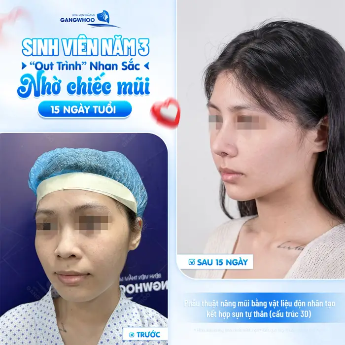 Sinh viên năm 3 nhan sắc đẹp thăng hạng và có điểm nhấn nhờ dáng mũi mới chỉ 15 ngày thực hiện đã hoàn toàn khác biệt
