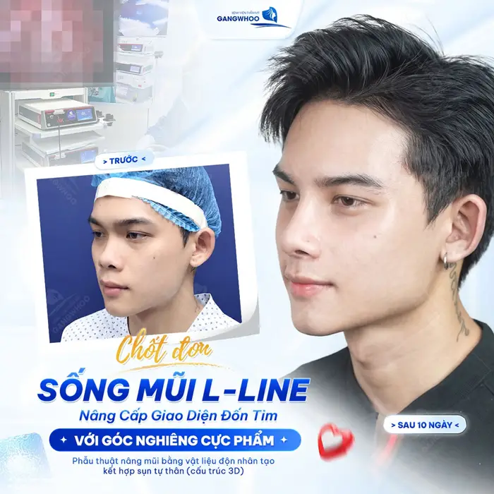 Nâng Mũi Nam Giới - Mũi Đẹp Chuẩn Men - Chuẩn Nam Thần 5 Nâng cấp diện mạo gương mặt thêm thần thái và bừng sắc sau 10 ngày visual đã đẹp chấn động