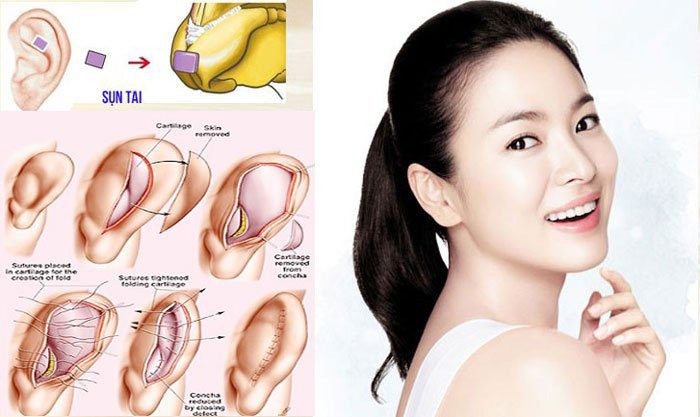 Sụn vành tai được sử dụng nhiều cho các ca nâng mũi lần đầu