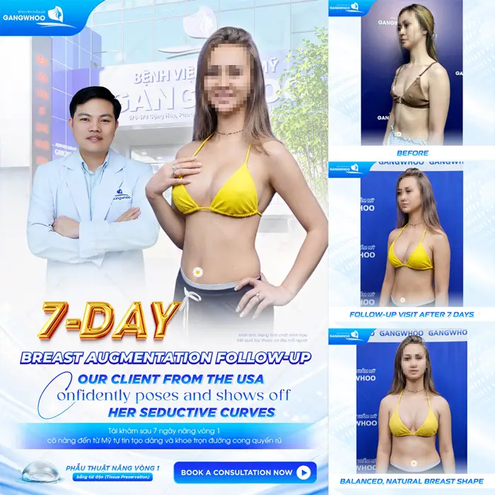 7 ngày sau nâng cấp vòng 1 khách hàng đến từ Mỹ body thăng hạng, tăng đường nét quyến rũ cho cơ thể