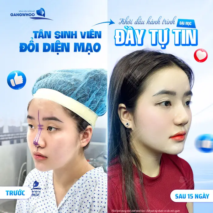 Nâng mũi thay đổi diện mạo mở ra hành trình đầy tự tin trong cuộc sống
