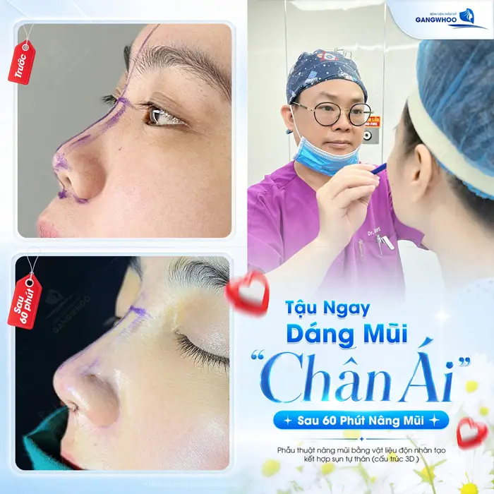 Dáng mũi đẹp "chân ái" sau 60 phút nâng mũi tự tin hơn ngay sau khi vừa phẫu thuật 