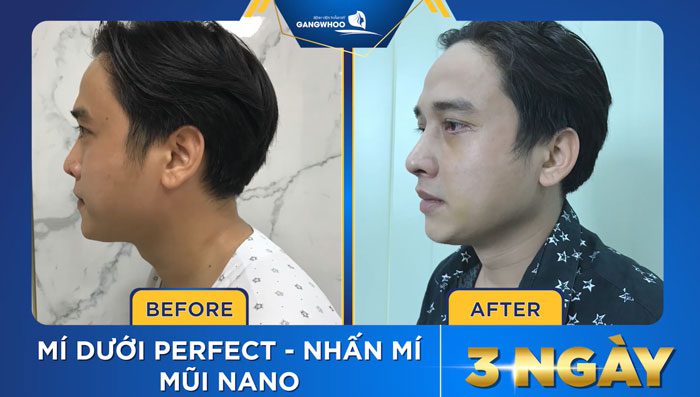 Image of Actor Thai Dinh Duong Before & After Undergoing Beauty Makeover